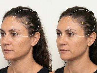 Antes/Después