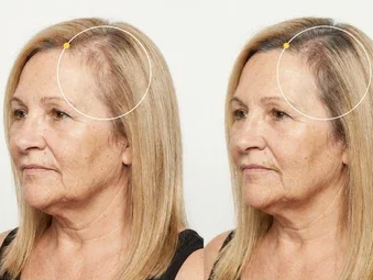 Antes/Después